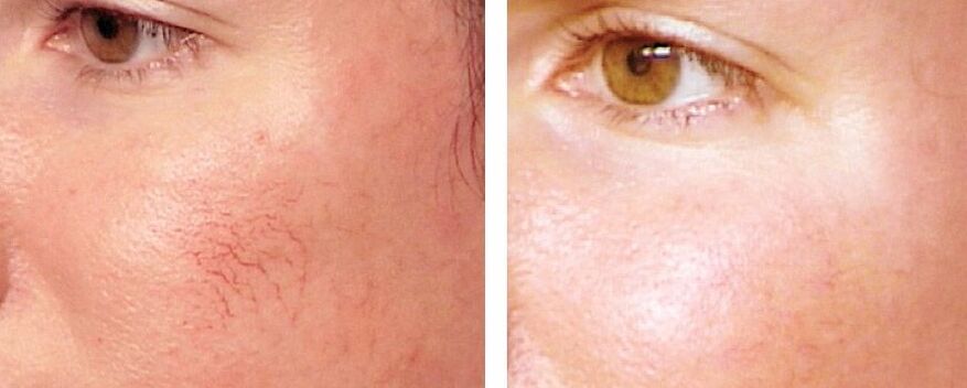 Rosacea removal