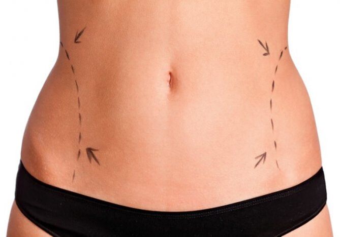 problem areas on the sides