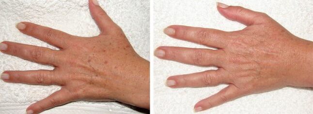 Result of removing pigment spots on hands