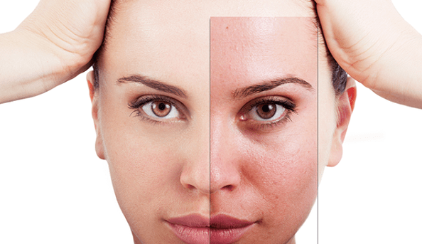 fractional rejuvenation removes the main aesthetic defects from the face