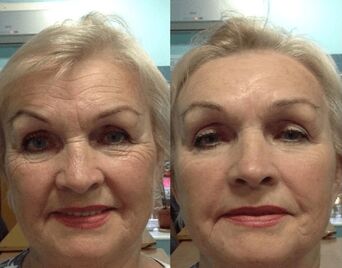 experience of using the Goji Cream anti-wrinkle cream - personal photo before and after